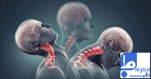 آرتروز گردن سالمندان